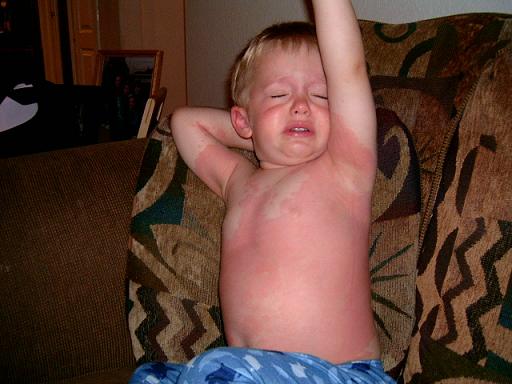 Hives on a little boy
